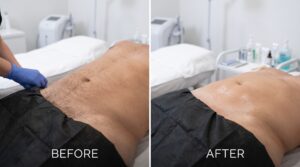 Male Brazilian wax before and after comparison showing visible hair growth before treatment and smooth skin after professional waxing.