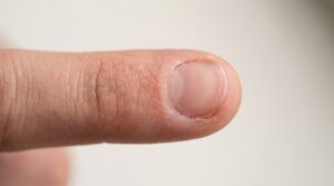 New fingernail growing back after nail loss
