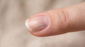 Early stage fingernail injury with bruising under the nail