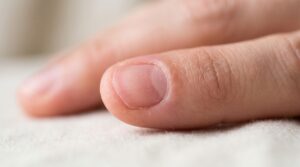 Fingernail that has fallen off after an injury