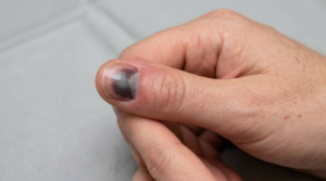 Black fingernail after an injury showing a subungual hematoma beneath the nail