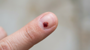 Small amount of blood under a fingernail after nail injury