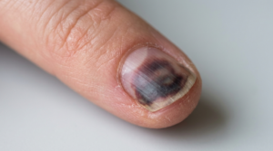 Bruised fingernail growing back normally with healthy new nail emerging from the base