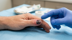 Bruised fingernail that should not be punctured or drained at home