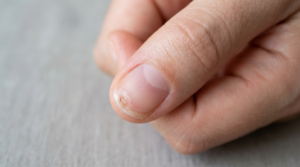 Healthy fingernail growing out after a nail injury