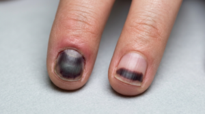 Black fingernail healing as healthy nail grows out after an injury