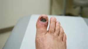 Bruised and slightly loose big toenail after a direct toe injury.