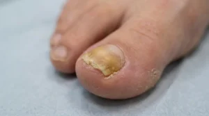 Thick, yellow, partially lifted toenail affected by a fungal nail infection.