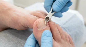 Person carefully trimming only the fully detached edge of a loose toenail.