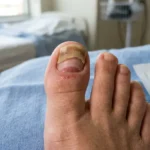 Partially detached big toenail showing early regrowth after an injury.