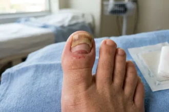 Partially detached big toenail showing early regrowth after an injury.