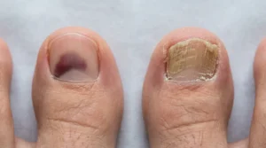 Smooth bruised toenail compared with a thick and brittle fungal toenail