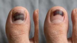 Bruised toenail discoloration growing toward the tip with healthy nail at the base