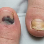 Bruised toenail compared with a thick, yellow fungal toenail