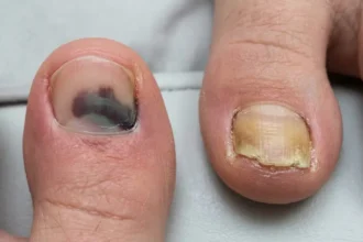 Bruised toenail compared with a thick, yellow fungal toenail