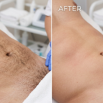 Manzilian before and after comparison showing male intimate area with visible hair stubble before waxing and smooth hair-free skin after professional Manzilian treatment.