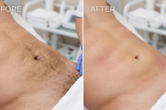 Manzilian before and after comparison showing male intimate area with visible hair stubble before waxing and smooth hair-free skin after professional Manzilian treatment.