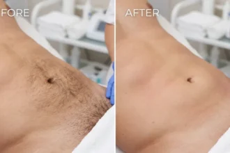 Manzilian before and after comparison showing male intimate area with visible hair stubble before waxing and smooth hair-free skin after professional Manzilian treatment.