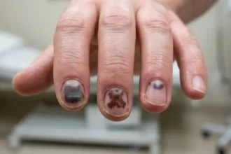 Realistic black fingernails with dark bruising beneath the nails after an injury
