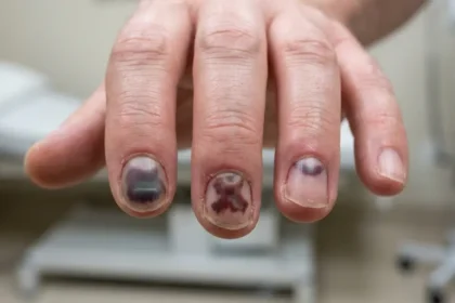 Realistic black fingernails with dark bruising beneath the nails after an injury