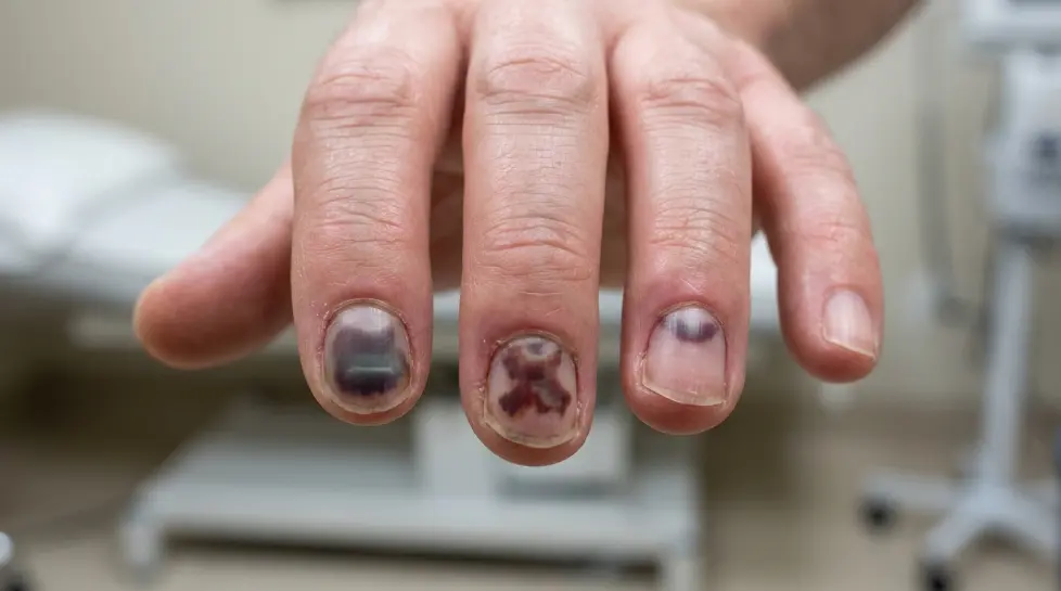 Realistic black fingernails with dark bruising beneath the nails after an injury