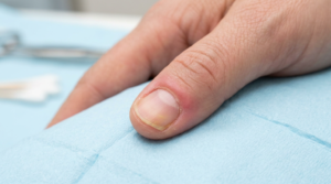 Fingernail showing redness, swelling, and discoloration associated with a nail infection