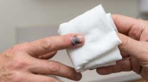Wrapped cold pack applied to a bruised fingernail after an injury