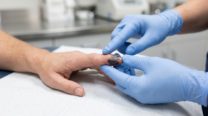 Healthcare professional examining a subungual hematoma to determine if nail drainage is needed