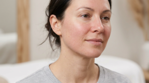 Skin looking calmer and smoother during the later stage of chemical peel recovery.