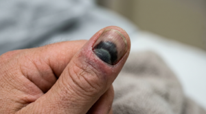 Blood trapped under the fingernail causing a dark subungual hematoma after injury.