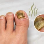 why do my toenails smell​ with moisture and odor around the toes