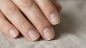 Natural fingernails showing peeling and roughness after acrylic nails were forcibly removed.