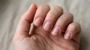 Thin, rough natural fingernails showing damage from over-filing.