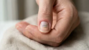 Natural fingernail showing mild damage and discoloration after pressure or trauma during removal.