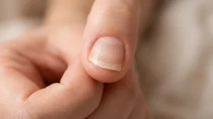 Natural fingernail lifted from the nail bed with a visible gap beneath the nail plate.