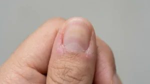 Natural fingernail with redness and irritation around the cuticle and surrounding skin.