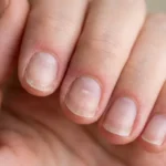 Thin, sensitive natural fingernails with mild redness after acrylic nail removal.