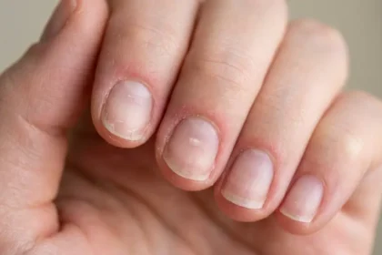 Thin, sensitive natural fingernails with mild redness after acrylic nail removal.