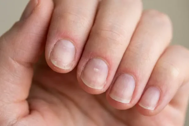 Thin, sensitive natural fingernails with mild redness after acrylic nail removal.