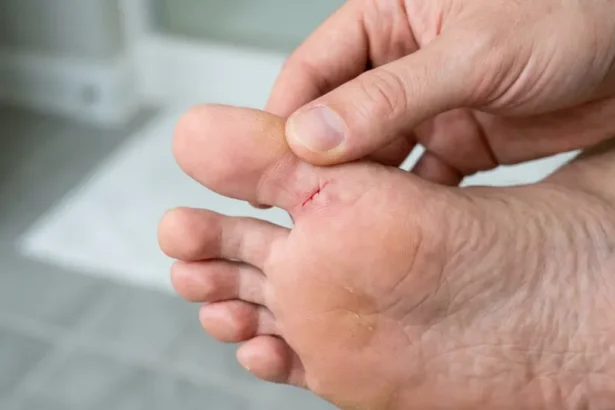 Close-up of a small cut under the toe that needs first aid treatment.