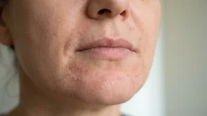 Early stage of perioral dermatitis healing as redness and bumps begin settling.