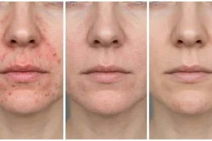 Three close-up stages of perioral dermatitis healing from active bumps to clear skin.