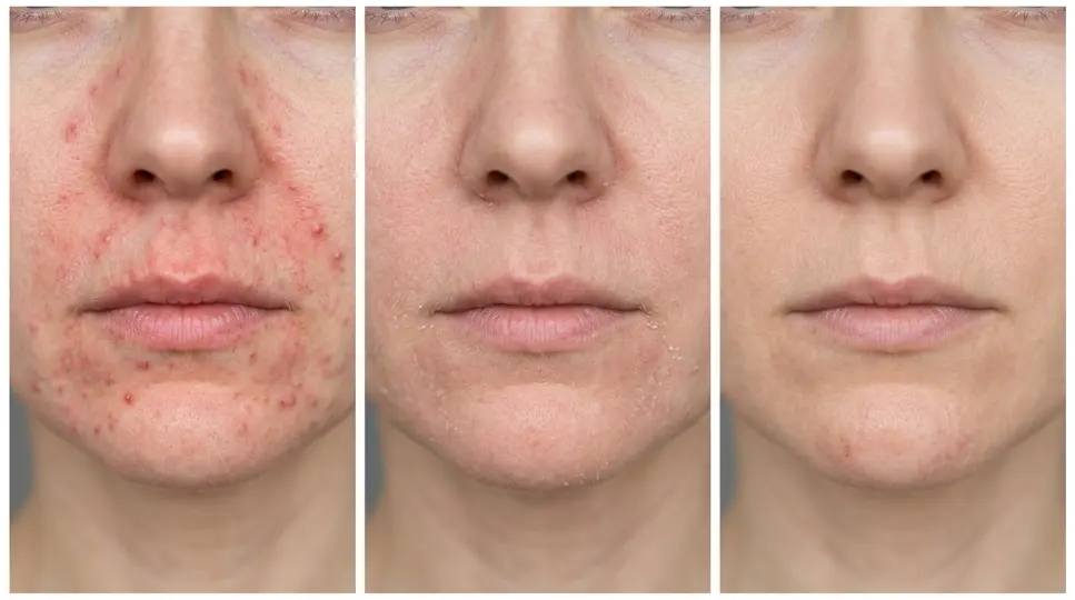 Three close-up stages of perioral dermatitis healing from active bumps to clear skin.