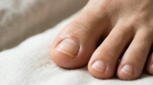 Sweat and bacteria trapped around the toenails