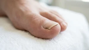 Debris collected beneath the toenail