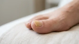 Toenail showing signs of fungal infection