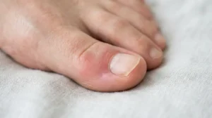 Toenail partially lifted from the nail bed