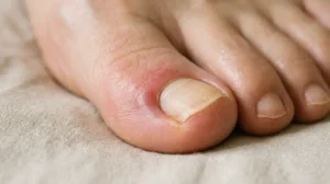 Infected skin around the toenail