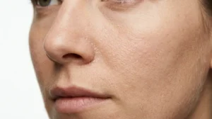 Dead skin buildup causing dry, dull, and flaky skin on the face