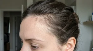 Close-up of short broken hairs and uneven strands around the hairline